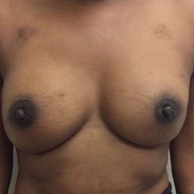 Direct to Implant Breast Reconstruction Before & After Gallery - Patient 154948844 - Image 2