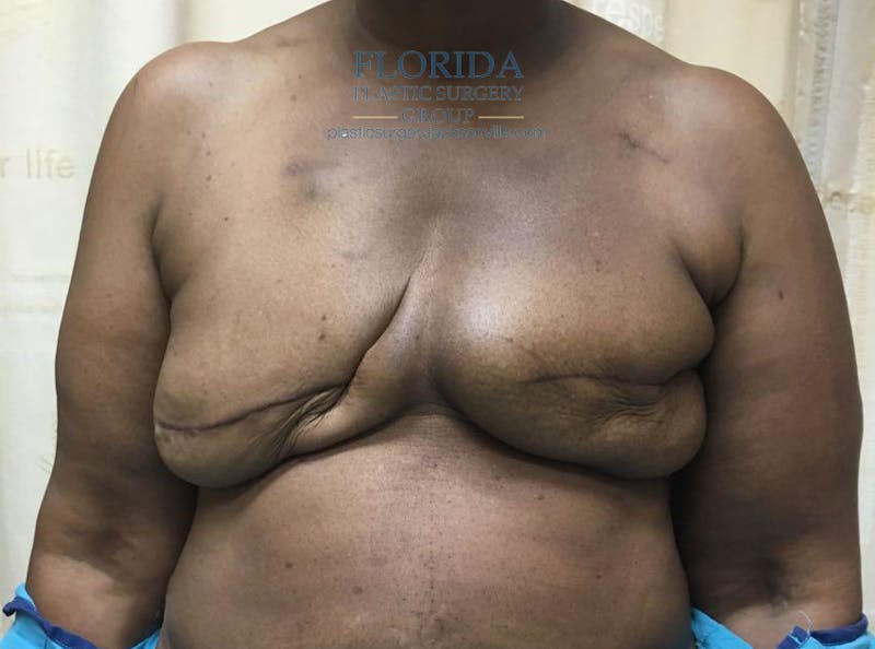 Latissimus Flap Reconstruction Before & After Gallery - Patient 154948855 - Image 1