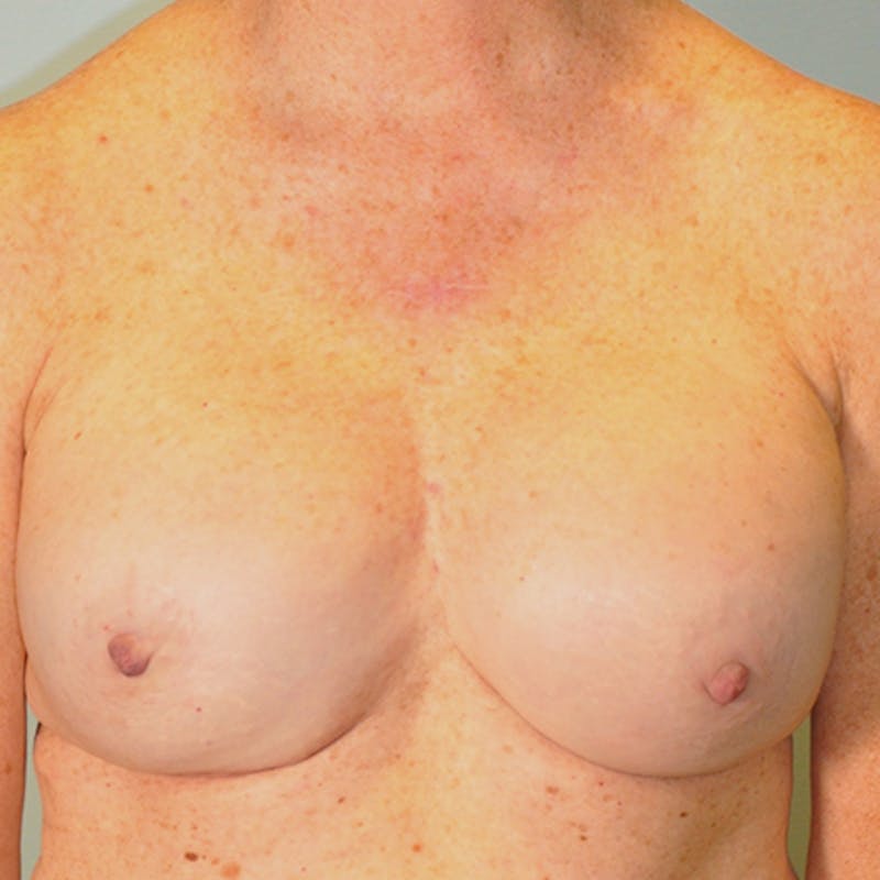 Nipple Sparing Breast Reconstruction Before & After Gallery - Patient 154948843 - Image 2