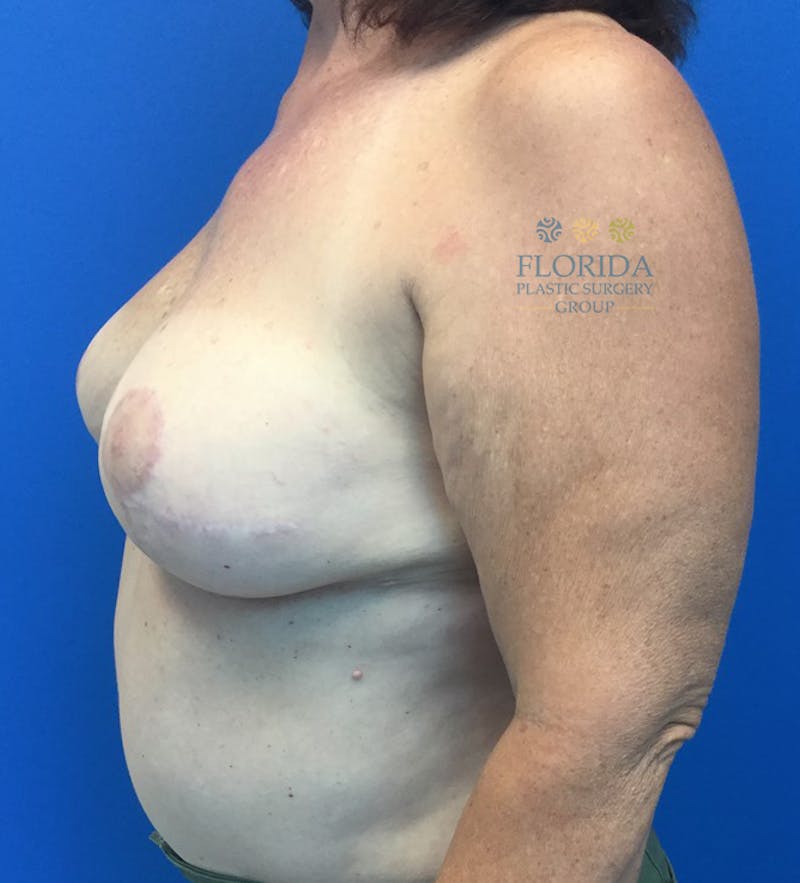 DIEP Flap Reconstruction Before & After Gallery - Patient 154948850 - Image 6