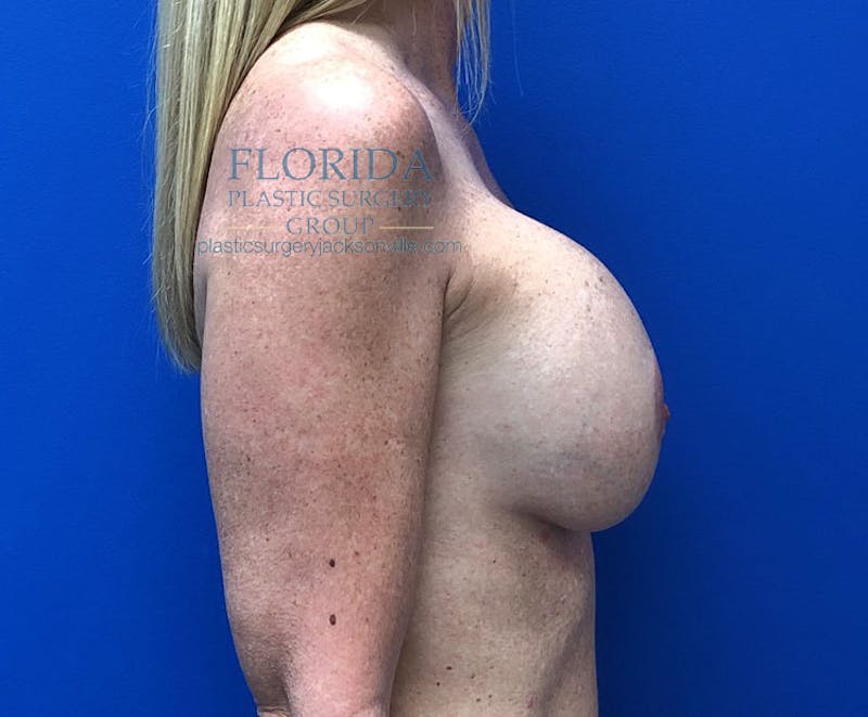 Augmentation Mastopexy Before & After Gallery - Patient 154948841 - Image 3