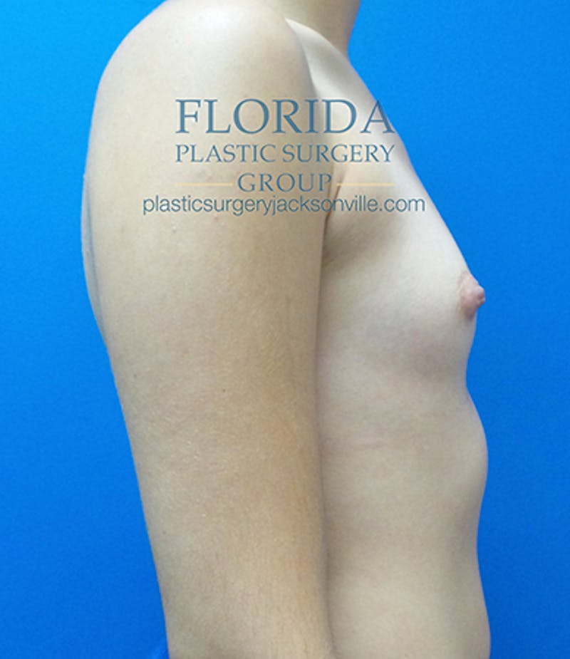 Saline Breast Augmentation Before & After Gallery - Patient 154948852 - Image 5