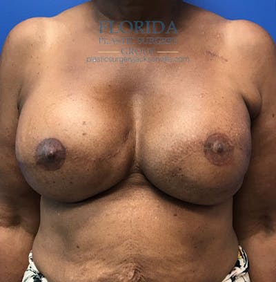 Latissimus Flap Reconstruction Before & After Gallery - Patient 154948855 - Image 2