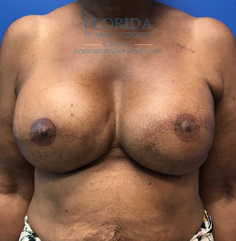 Latissimus Flap Reconstruction Before & After Gallery - Patient 154948855 - Image 2