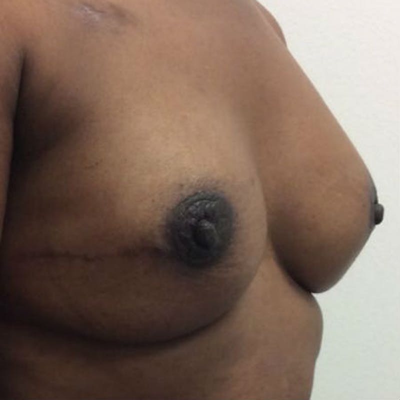 Direct to Implant Breast Reconstruction Before & After Gallery - Patient 154948844 - Image 4