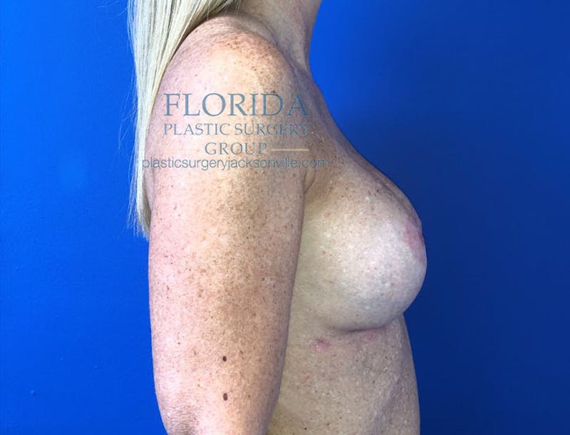 Augmentation Mastopexy Before & After Gallery - Patient 154948841 - Image 4