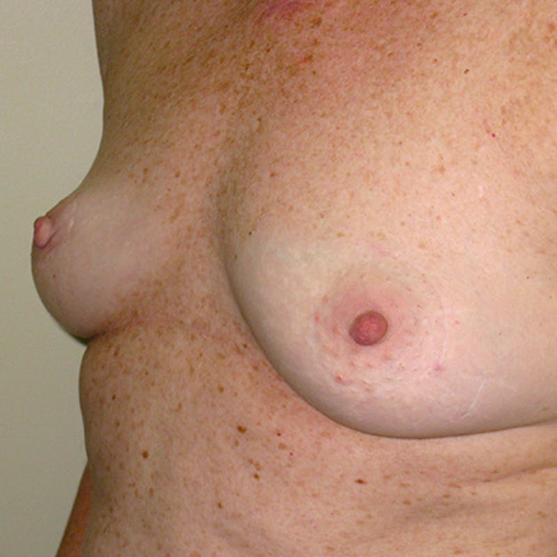 Nipple Sparing Breast Reconstruction Before & After Gallery - Patient 154948843 - Image 3