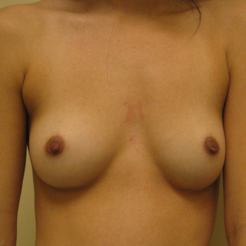 Silicone Breast Augmentation Before & After Gallery - Patient 154948851 - Image 1