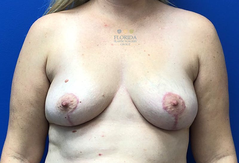 Post Lumpectomy Reconstruction Before & After Gallery - Patient 154948849 - Image 2
