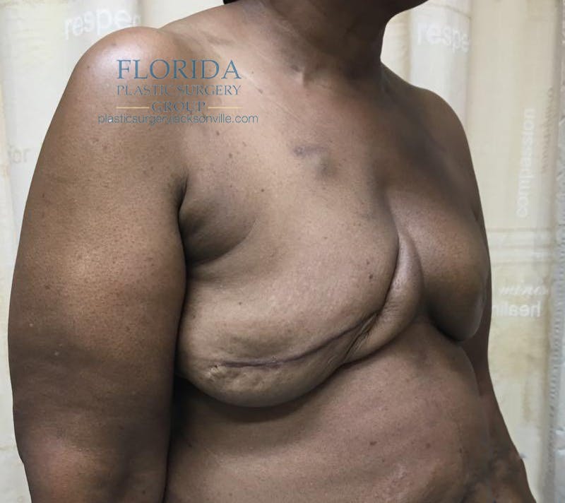 Latissimus Flap Reconstruction Before & After Gallery - Patient 154948855 - Image 3