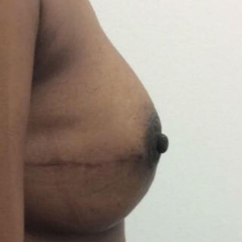 Direct to Implant Breast Reconstruction Before & After Gallery - Patient 154948844 - Image 6