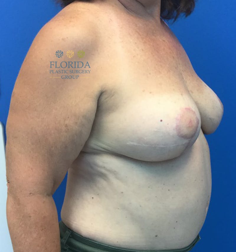 DIEP Flap Reconstruction Before & After Gallery - Patient 154948850 - Image 8