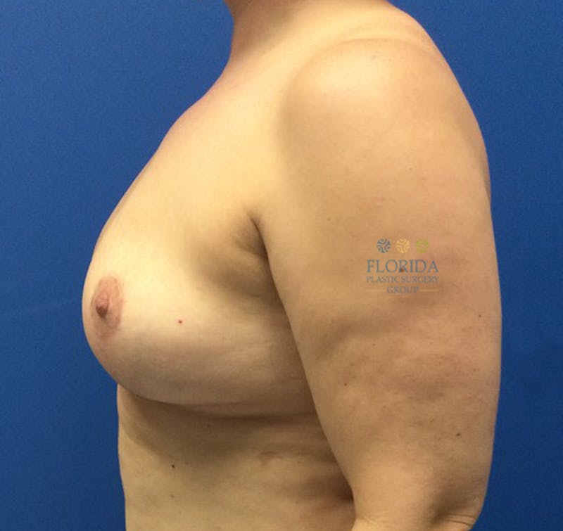 Breast Implant Removal Before & After Gallery - Patient 154948847 - Image 4