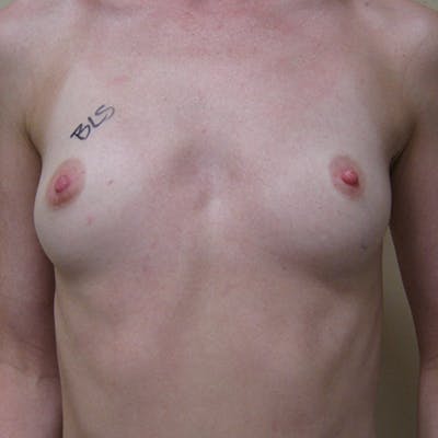 Nipple Sparing Breast Reconstruction Before & After Gallery - Patient 154948859 - Image 1