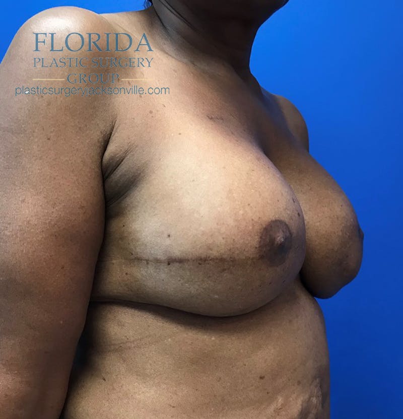 Latissimus Flap Reconstruction Before & After Gallery - Patient 154948855 - Image 4