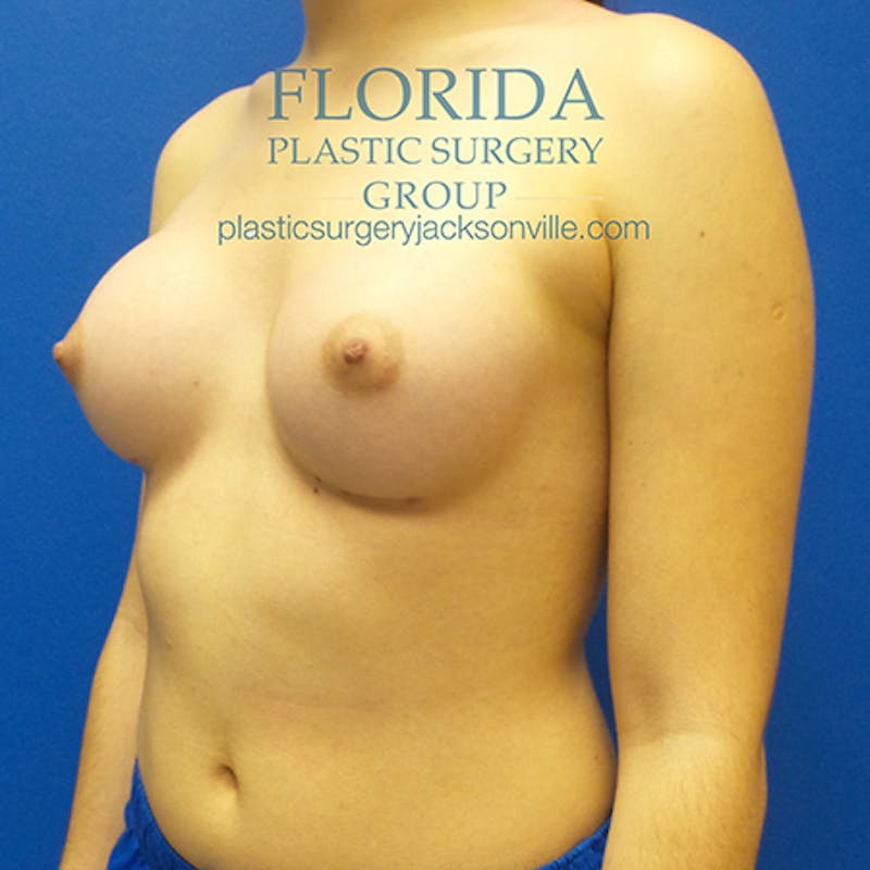 Saline Breast Augmentation Before & After Gallery - Patient 154948852 - Image 8