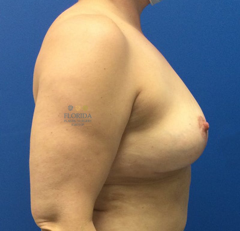 Breast Implant Removal Before & After Gallery - Patient 154948847 - Image 6