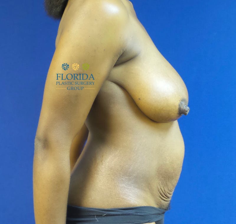 Breast Lift Before & After Gallery - Patient 154948856 - Image 1