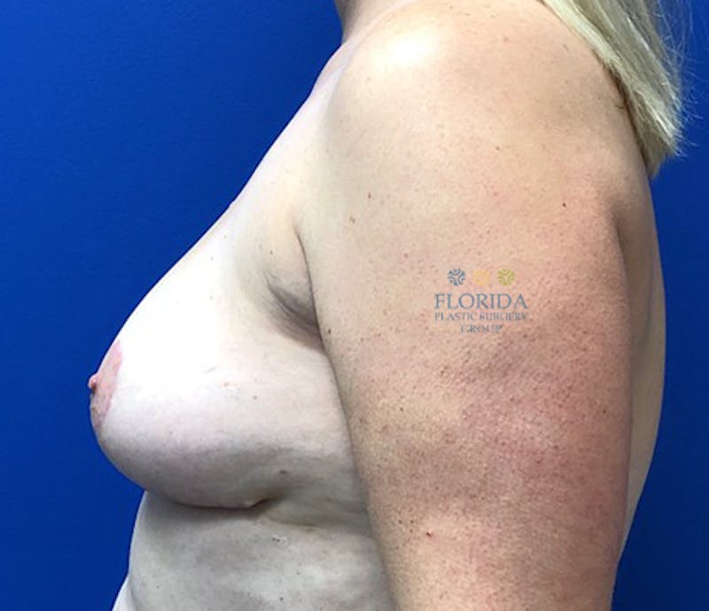 Post Lumpectomy Reconstruction Before & After Gallery - Patient 154948849 - Image 4