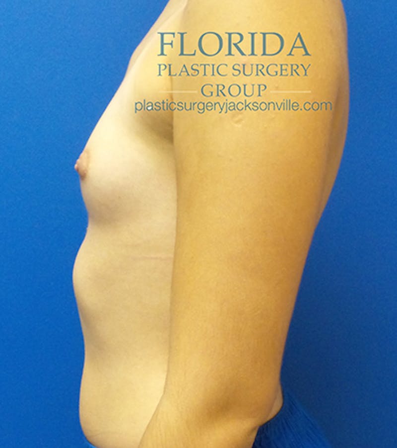 Saline Breast Augmentation Before & After Gallery - Patient 154948852 - Image 9