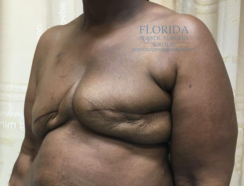 Latissimus Flap Reconstruction Before & After Gallery - Patient 154948855 - Image 5