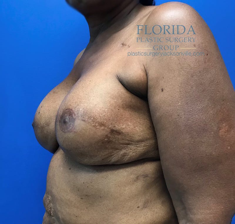 Latissimus Flap Reconstruction Before & After Gallery - Patient 154948855 - Image 6
