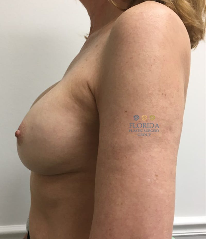 Direct to Implant Breast Reconstruction Before & After Gallery - Patient 154948864 - Image 3