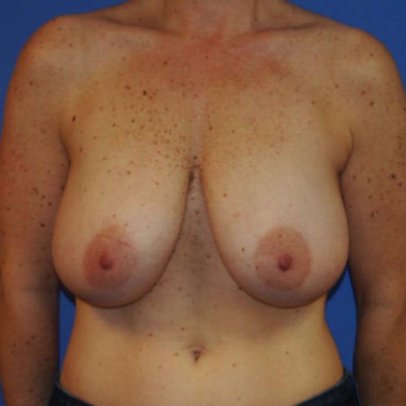 Post Lumpectomy Reconstruction Before & After Gallery - Patient 154948861 - Image 1