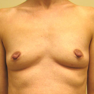 Silicone Breast Augmentation Before & After Gallery - Patient 154948862 - Image 1