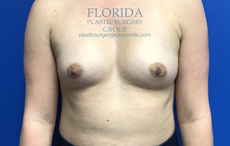Saline Breast Augmentation Before & After Gallery - Patient 154948876 - Image 1