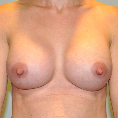 Silicone Breast Augmentation Before & After Gallery - Patient 154948862 - Image 2