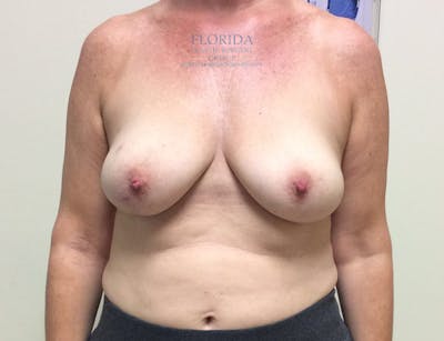 Latissimus Flap Reconstruction Before & After Gallery - Patient 154948868 - Image 1