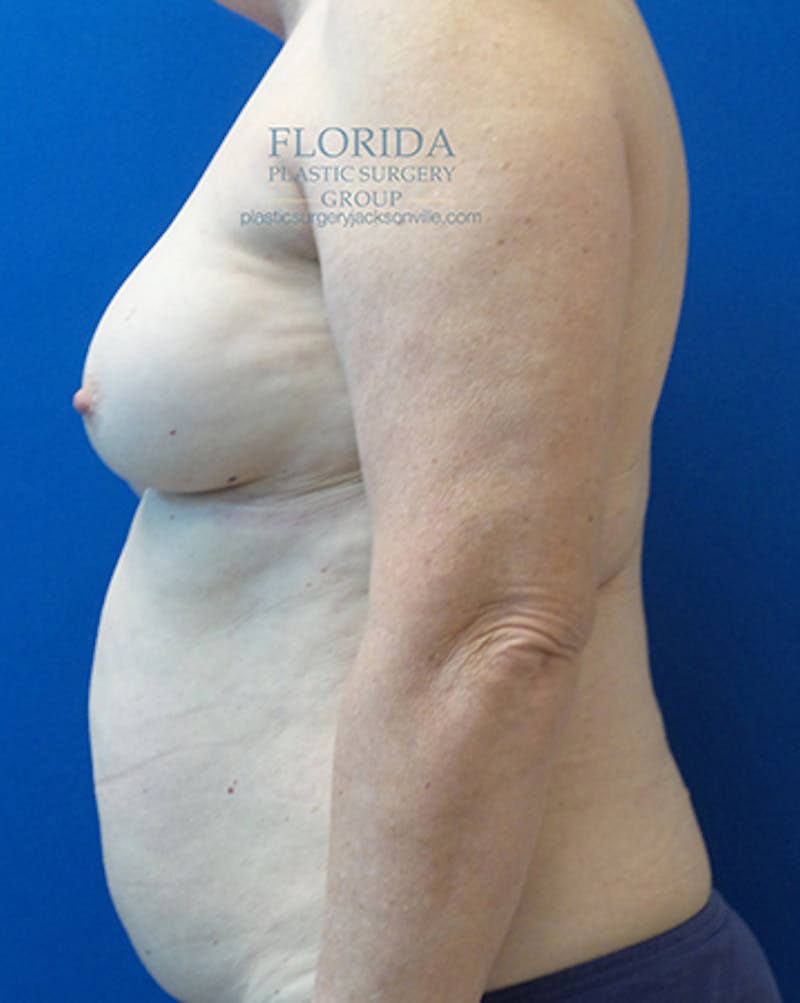 DIEP Flap Reconstruction Before & After Gallery - Patient 154948874 - Image 3