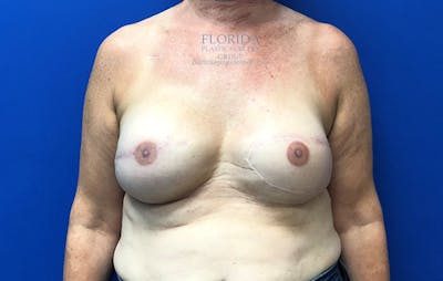 Latissimus Flap Reconstruction Before & After Gallery - Patient 154948868 - Image 2