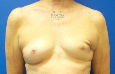 Tissue Expander Reconstruction Before & After Gallery - Patient 154948871 - Image 1