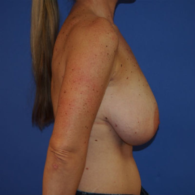Post Lumpectomy Reconstruction Before & After Gallery - Patient 154948861 - Image 5