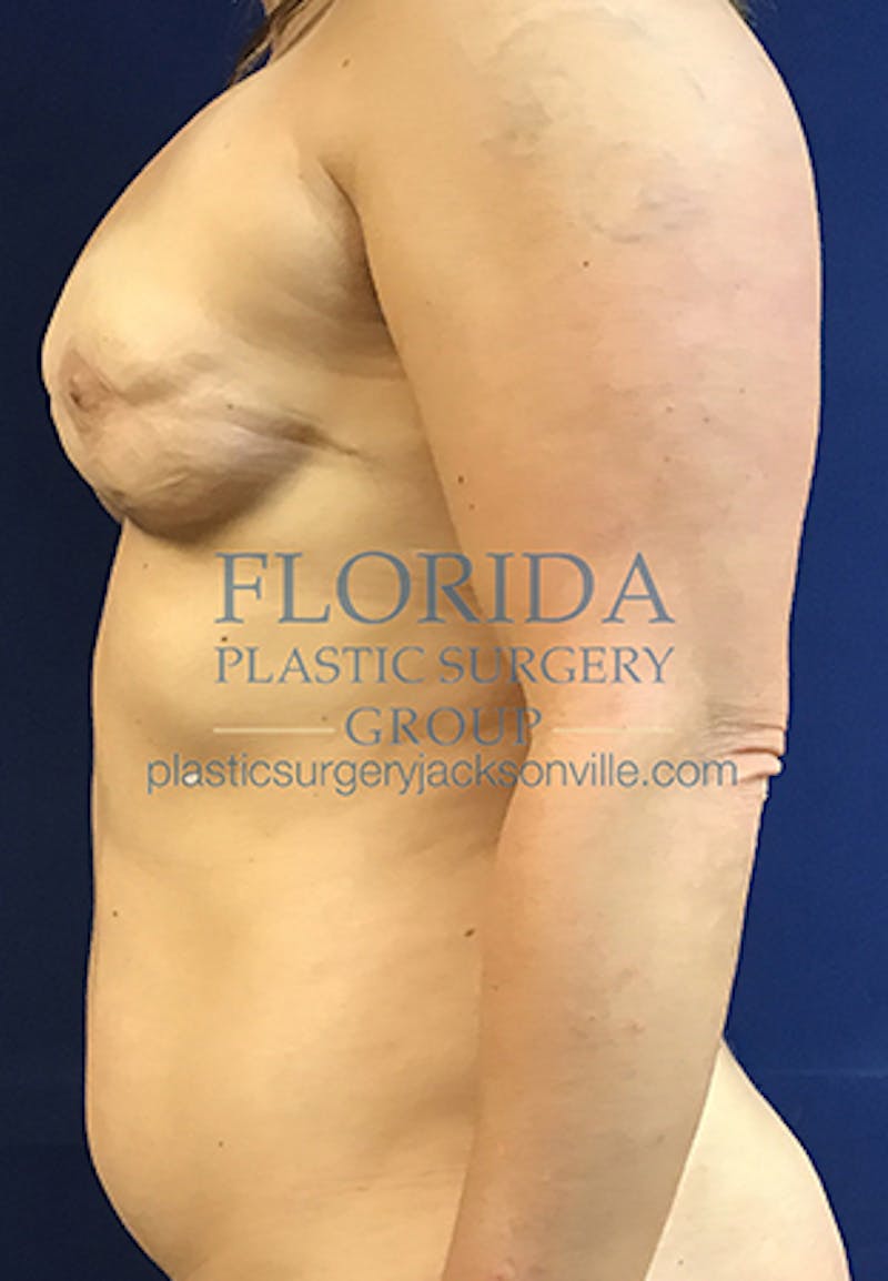 Breast Reconstruction Revision Before & After Gallery - Patient 154948866 - Image 5