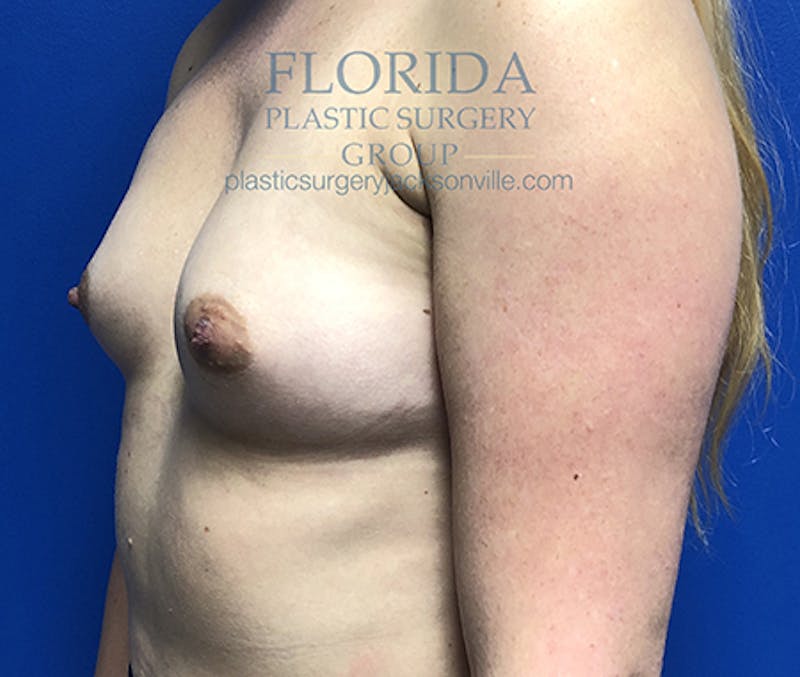 Saline Breast Augmentation Before & After Gallery - Patient 154948876 - Image 3