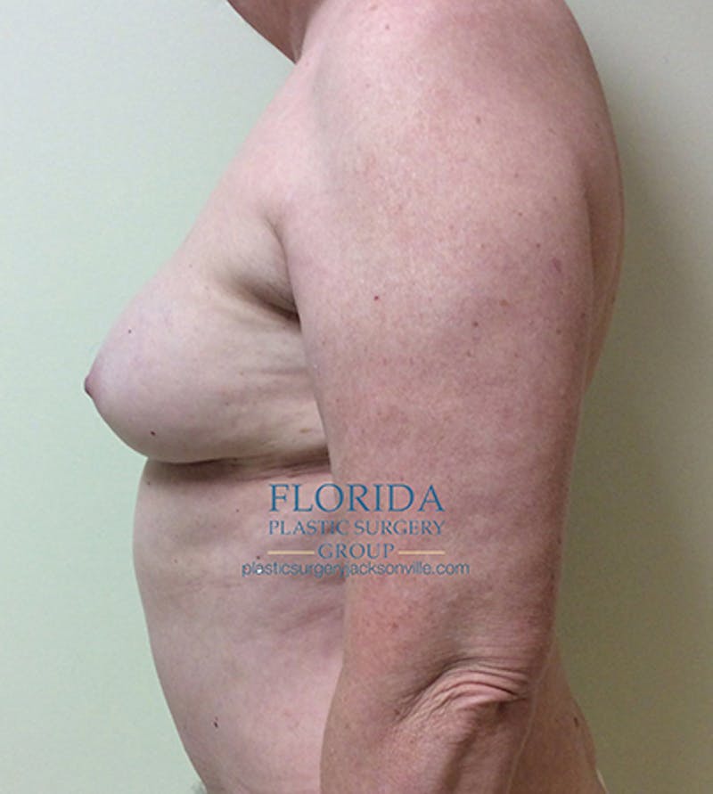 DIEP Flap Reconstruction Before & After Gallery - Patient 154948874 - Image 4