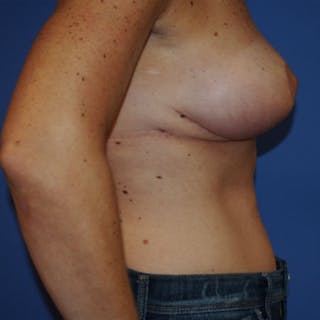 Post Lumpectomy Reconstruction Before & After Gallery - Patient 154948861 - Image 6
