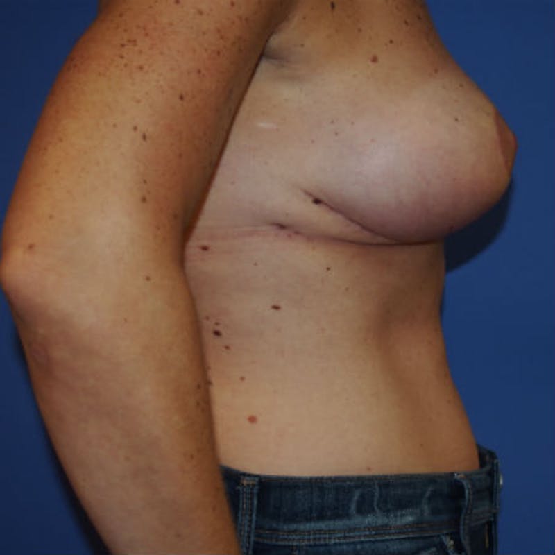 Post Lumpectomy Reconstruction Before & After Gallery - Patient 154948861 - Image 6