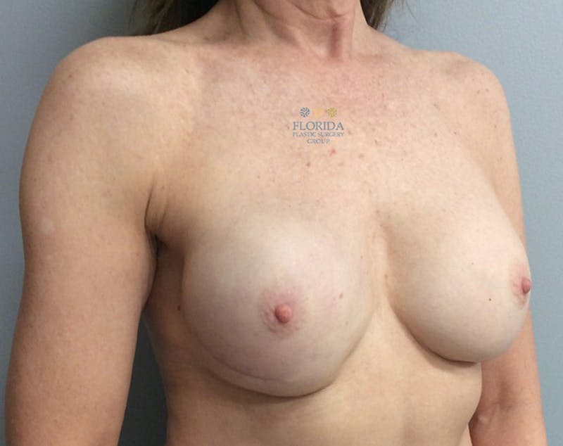 Direct to Implant Breast Reconstruction Before & After Gallery - Patient 154948864 - Image 6