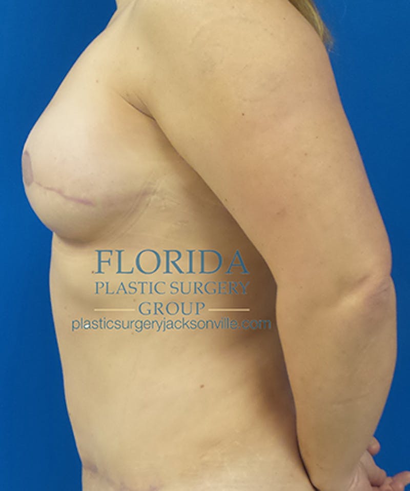 Breast Reconstruction Revision Before & After Gallery - Patient 154948866 - Image 6