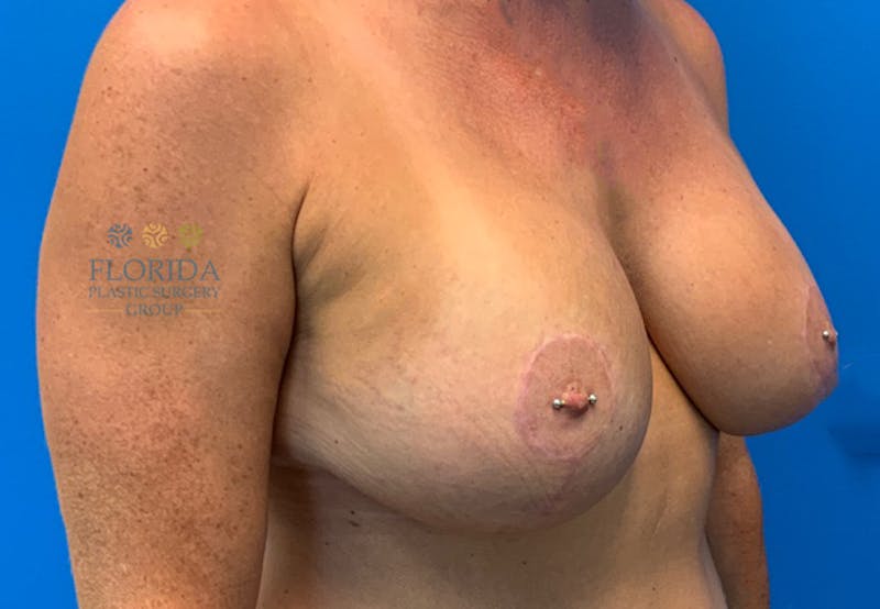 Augmentation Mastopexy Before & After Gallery - Patient 154948865 - Image 4