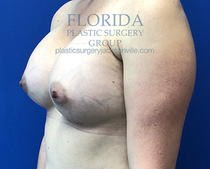 Saline Breast Augmentation Before & After Gallery - Patient 154948876 - Image 4