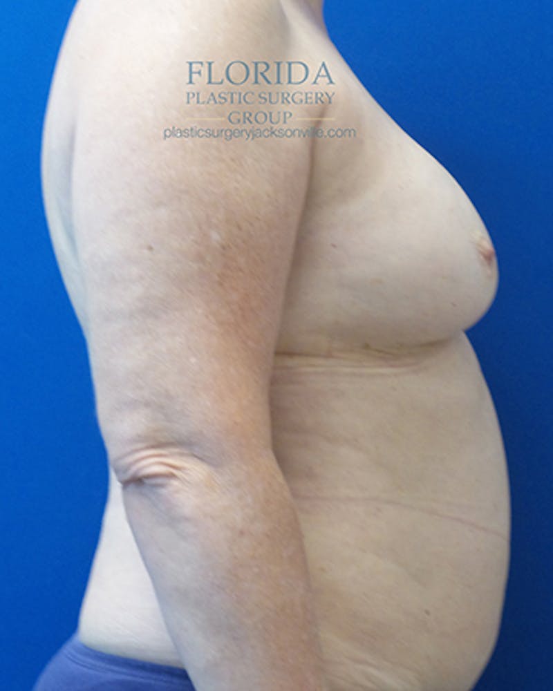 DIEP Flap Reconstruction Before & After Gallery - Patient 154948874 - Image 5