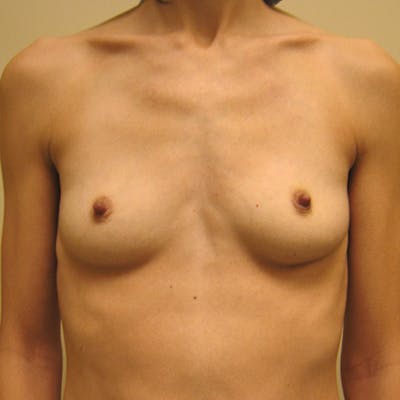 Silicone Breast Augmentation Before & After Gallery - Patient 154948869 - Image 1