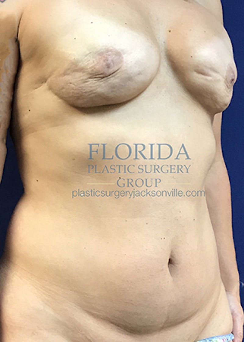 Breast Reconstruction Revision Before & After Gallery - Patient 154948866 - Image 7