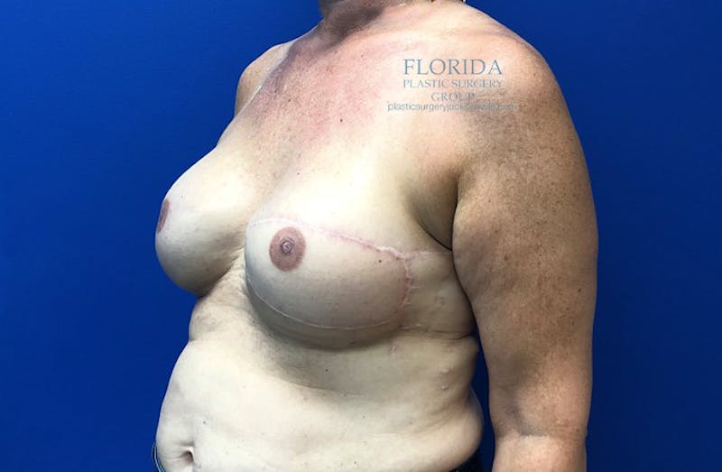 Latissimus Flap Reconstruction Before & After Gallery - Patient 154948868 - Image 4