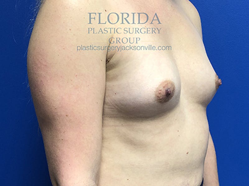 Saline Breast Augmentation Before & After Gallery - Patient 154948876 - Image 5